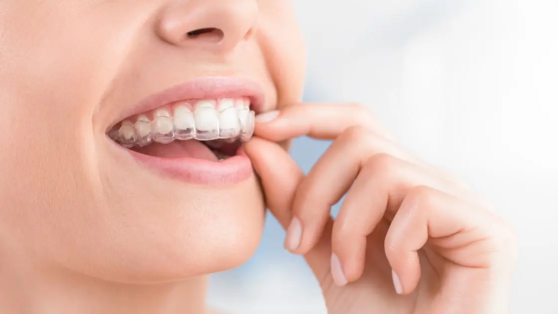 Sorriso Alinhado e Moderno: Tudo o que Você Precisa Saber Sobre Aparelho Invisível